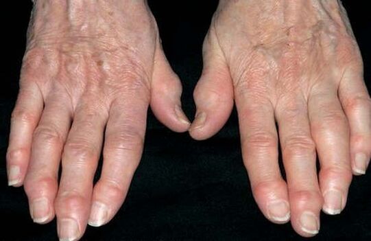Artrosi delle mani