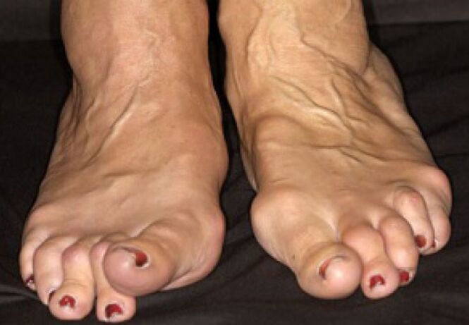 Completamento dell'osteoartrite