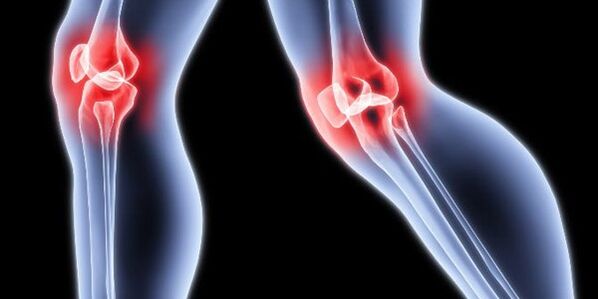 Osteoartrosi del ginocchio