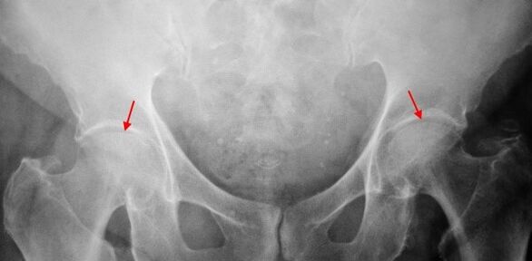 Immagine coksartrosio a doppia faccia del divario comune, sclerosi delle superfici articolari