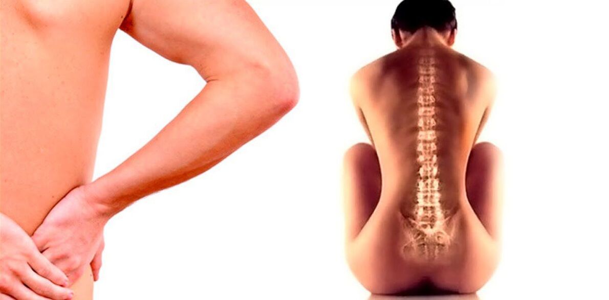 Dolore lombare dovuto all'osteocondrosi