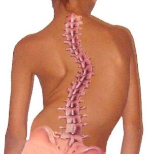 La curvatura della colonna vertebrale porta all'osteocondrosi