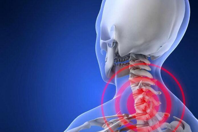 Il dolore lancinante al collo è un sintomo precoce dell'osteocondrosi cervicale