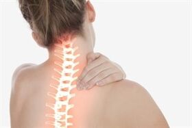 Osteocondrosi cervicale in una donna
